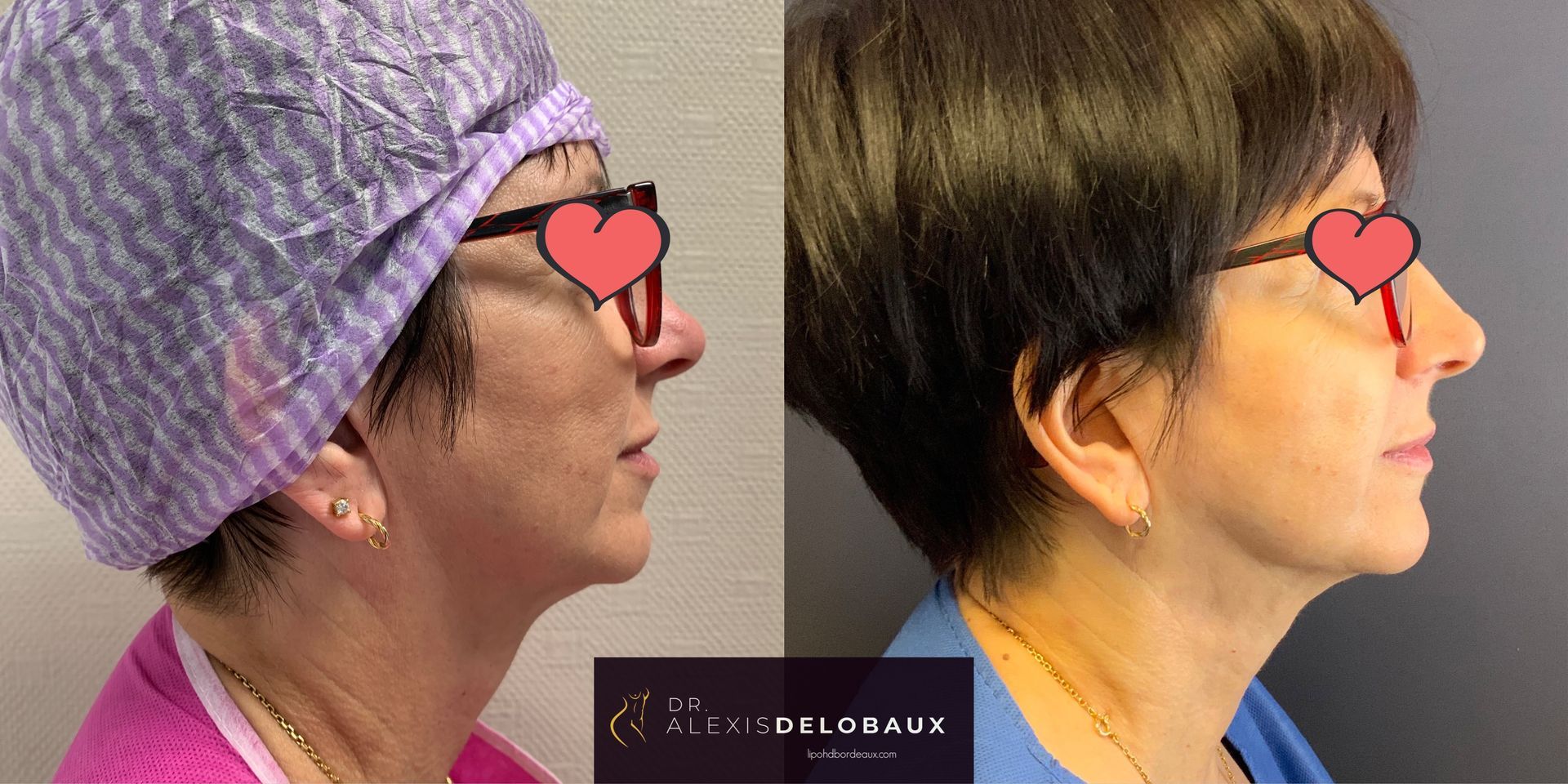 Liposuccion Des Bras Et Lipoaspiration Paris Dr Delobaux